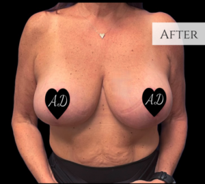 Breast Reduction